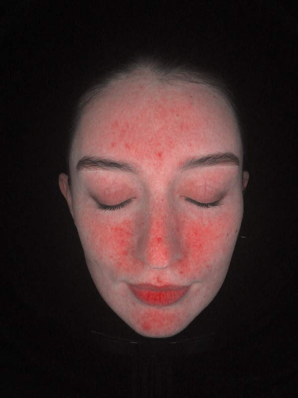Analizador de piel Meicet analizador de acné MC88 área roja