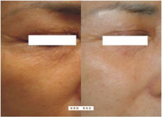 基础抗衰前后对比Mesoterapimaskine anti-aging