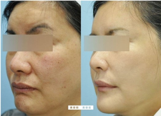 消炎祛痘前后对比 Macchina per mesoterapia trattamento antinfiammatorio dell'acne