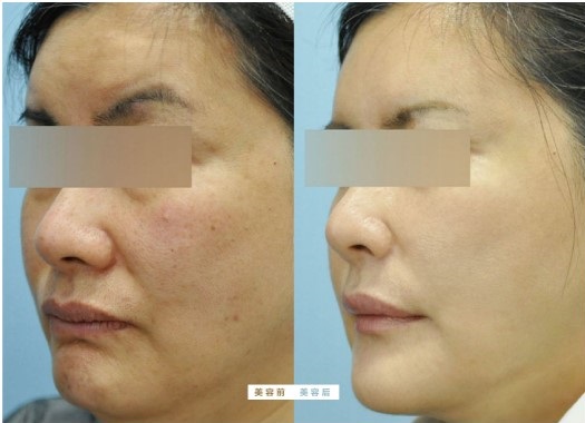 消炎祛痘前后对比 Mesotherapy යන්ත්‍රය ප්‍රදාහ නාශක කුරුලෑ ප්‍රතිකාරය