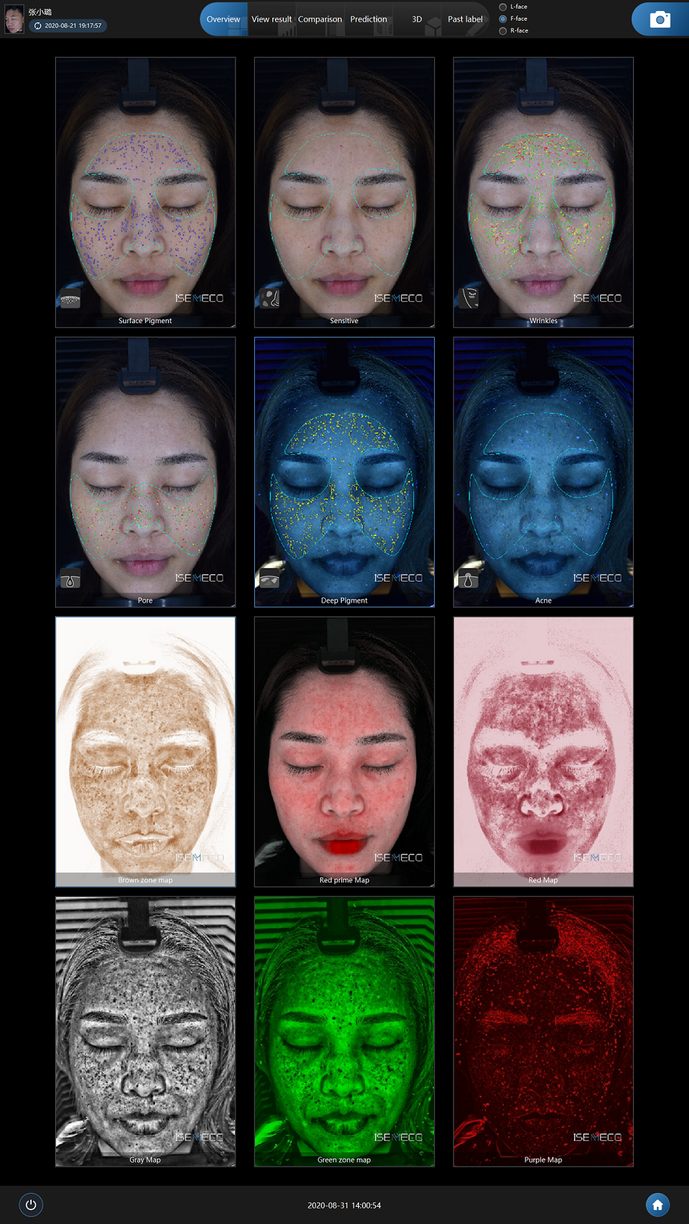 Diagnosis and Treatment of Melasma, and Early Detection with Skin Analyzer