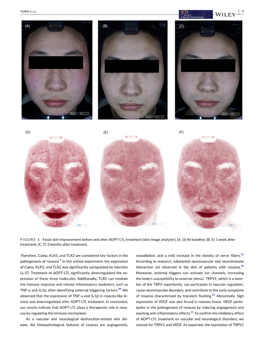 Novel technique for rosacea treatment using optimal pulse technology: In vivo and clinical studies