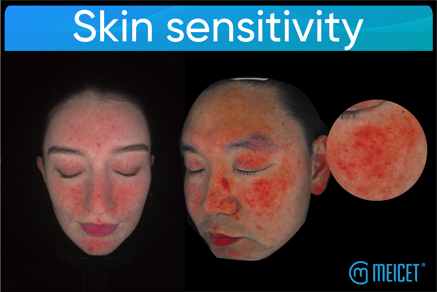فهم حساسية الجلد: الأسباب والأنواع واستراتيجيات العلاج ودور أجهزة تحليل الجلد