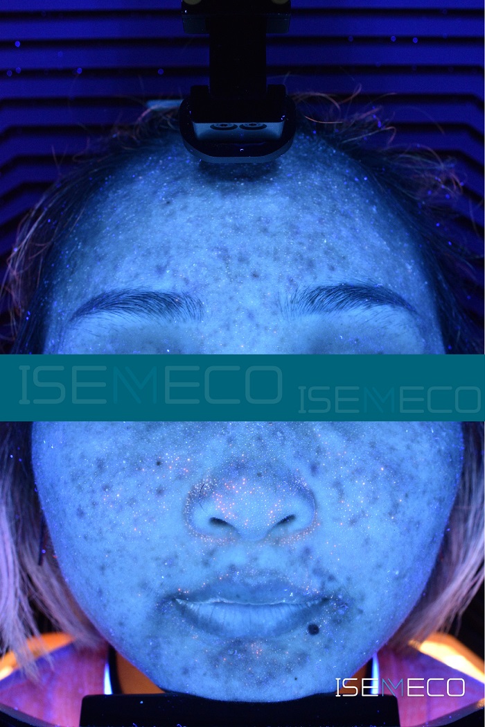 MEICET skin analyzer ISEMECO UV light true case