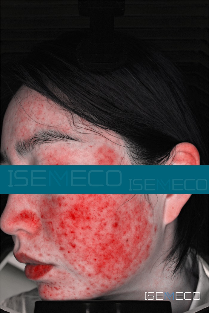 The Protective Effect of Skin Microecology on Skin