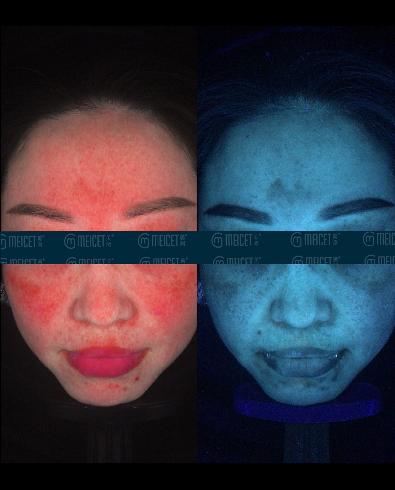 Meicet skin analyzer acne scanners acne and pigmentation