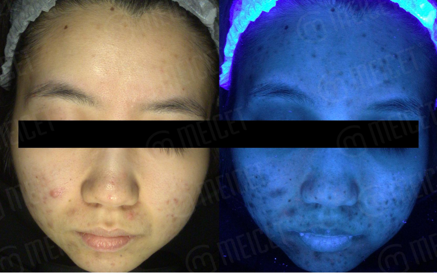 Why skin analyzer machine can detect skin problems?
