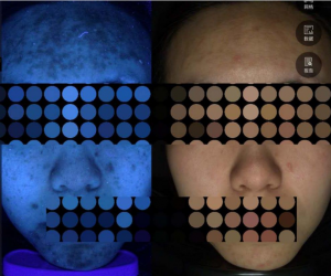 Meicet 3D Skin Analysi Skin Analyzer Acne Scanner MC88