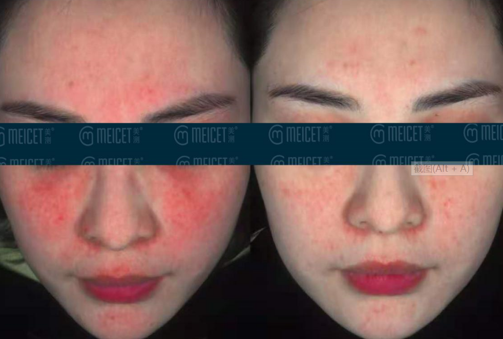Anti-allergic cosmetics and epidermal sensitivity