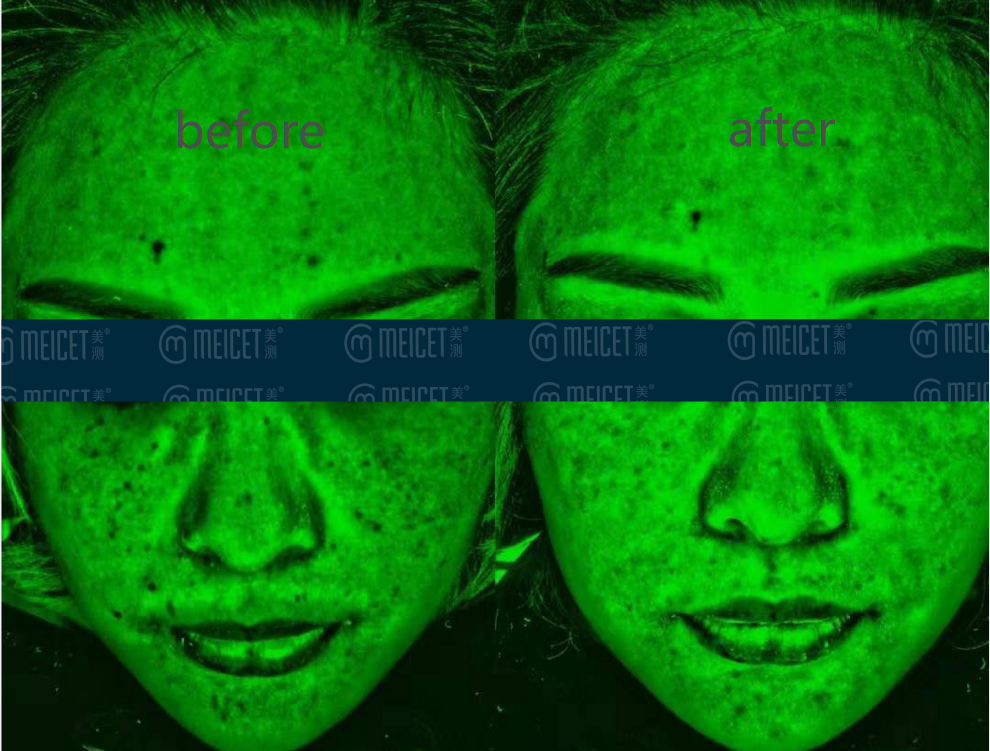 Whitening Cosmetics and Pigment Metabolism