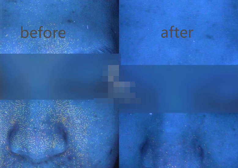 Epidermis and Acne