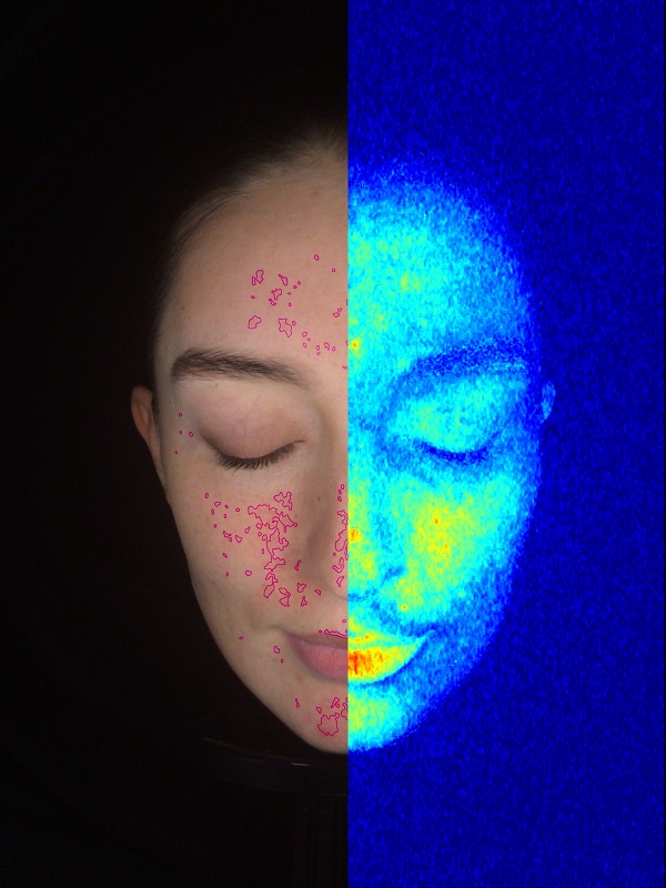 skin analyzer sensitivity heat map
