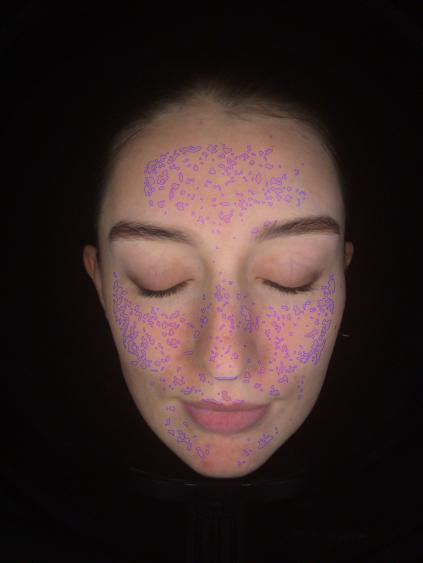 surface skin spots skin analyzer