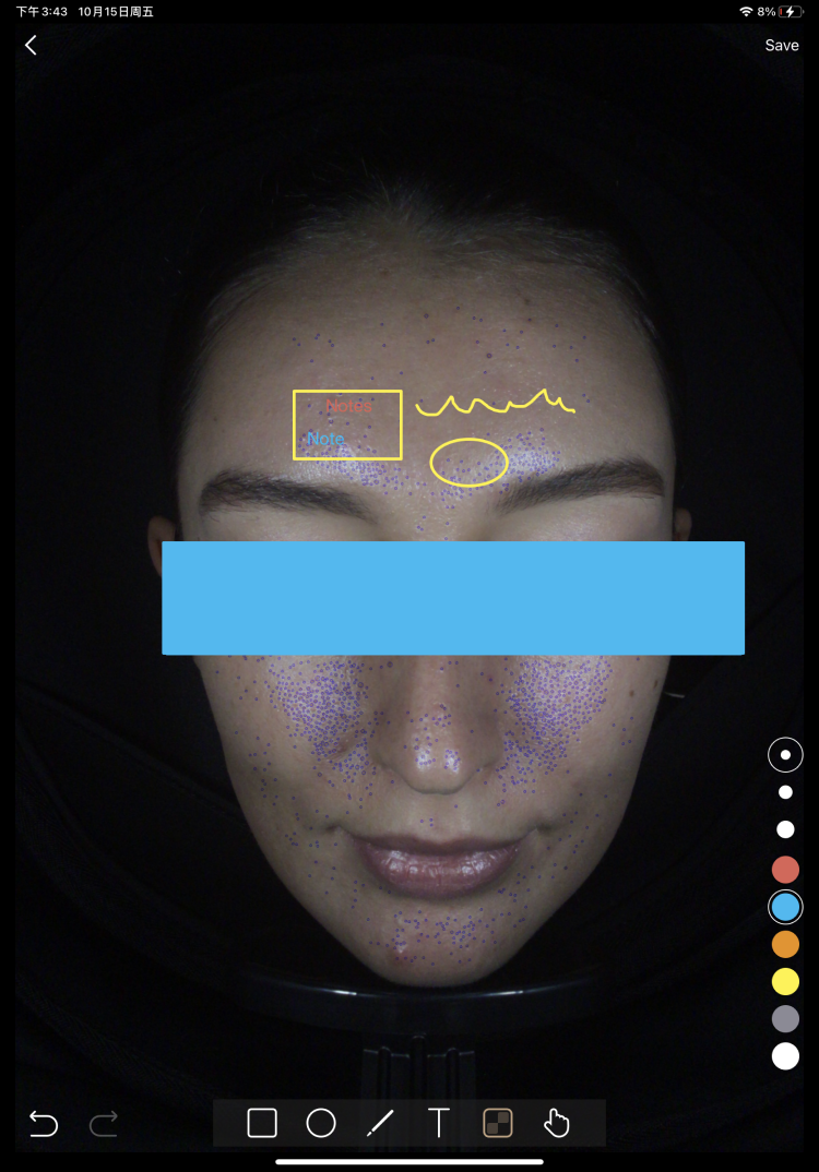 I-Postinflammatory Hyperpigmentation (PIH)