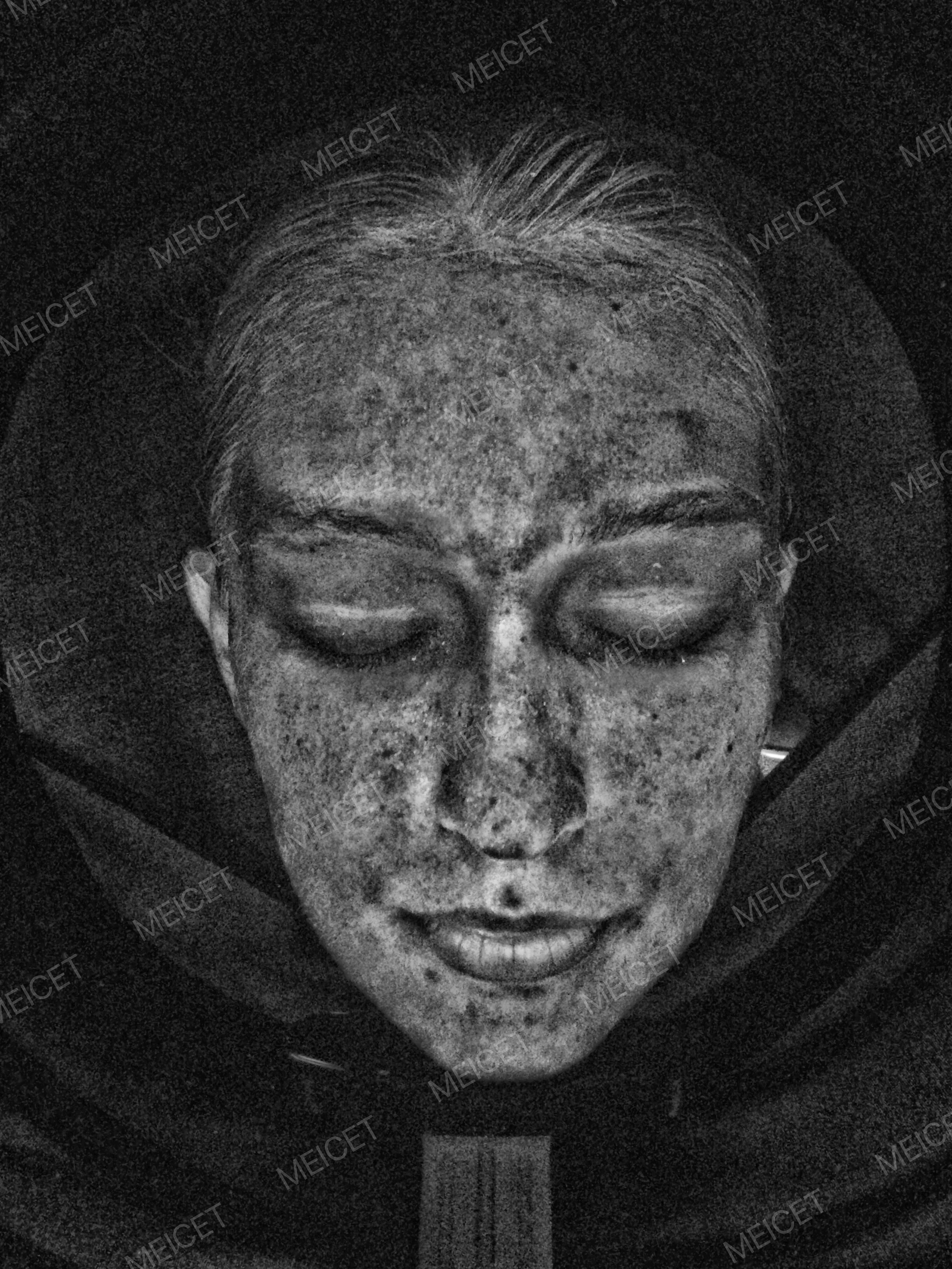 The Formation, Types, and Treatment of Melasma and Freckles